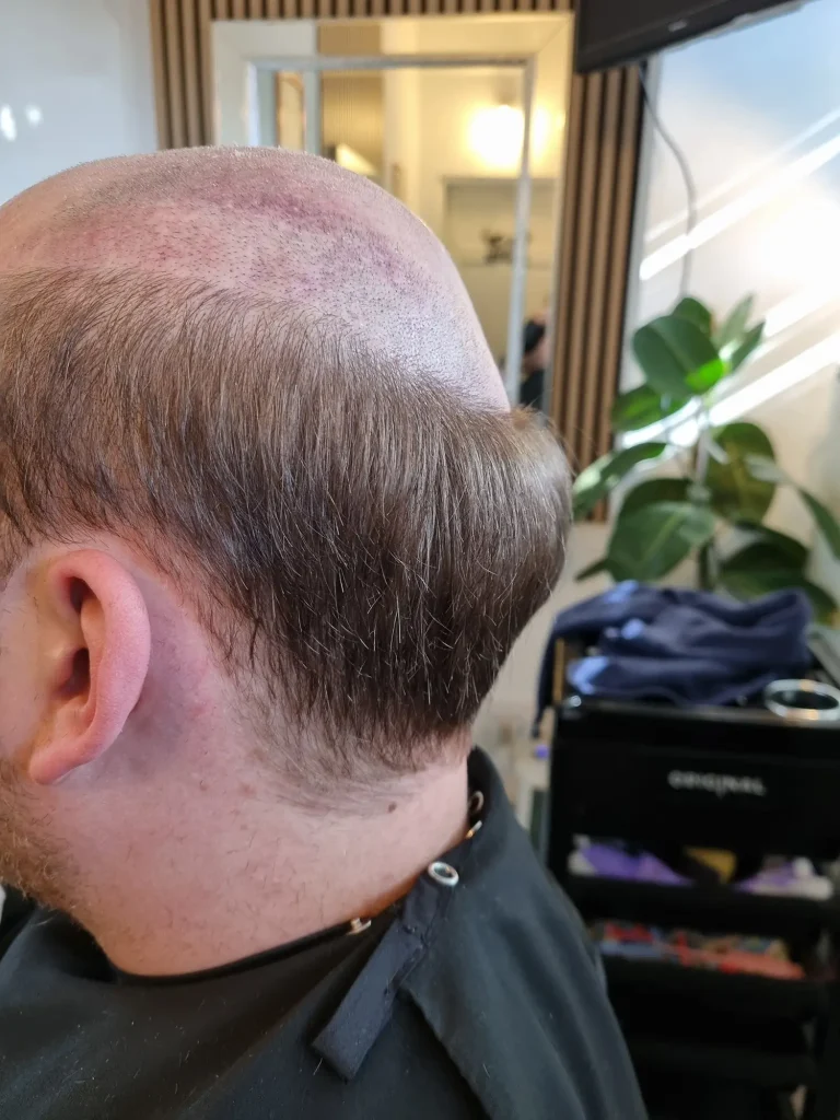 Clarity Hair Solutions client before fitting a bespoke hair system.