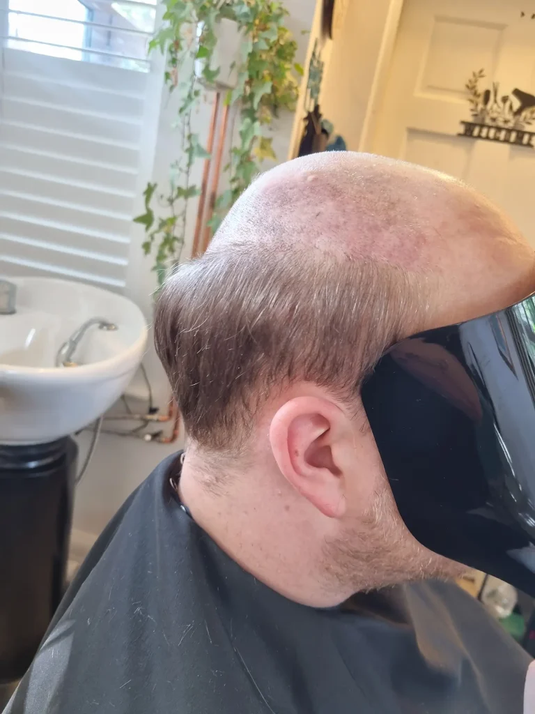 Clarity Hair Solutions client before fitting a bespoke hair system.